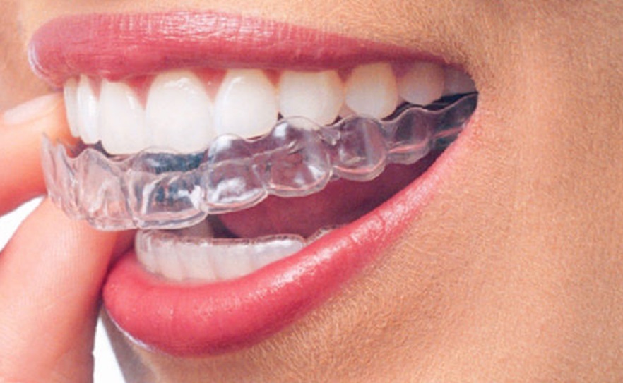 Teeth Straightening
