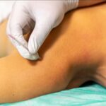 First Dry Needling Session