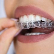 The Science Behind Modern Braces And Aligners