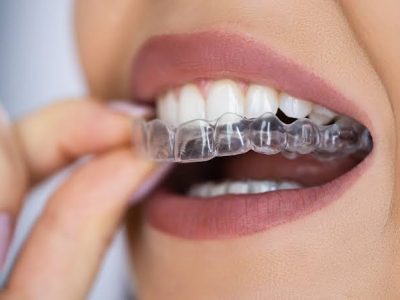 The Science Behind Modern Braces And Aligners