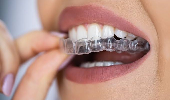 The Science Behind Modern Braces And Aligners