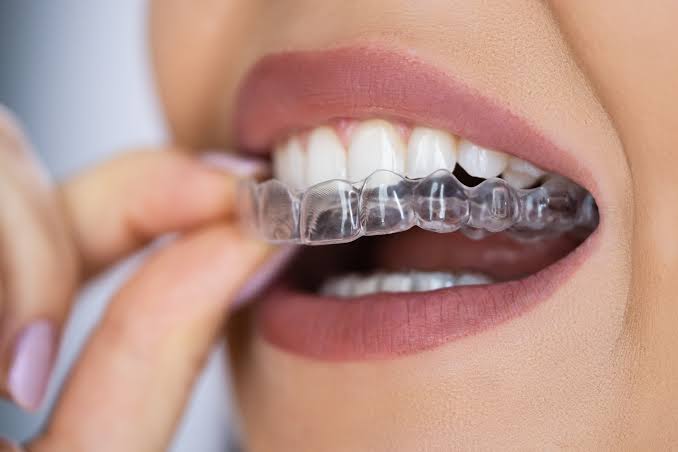 The Science Behind Modern Braces And Aligners